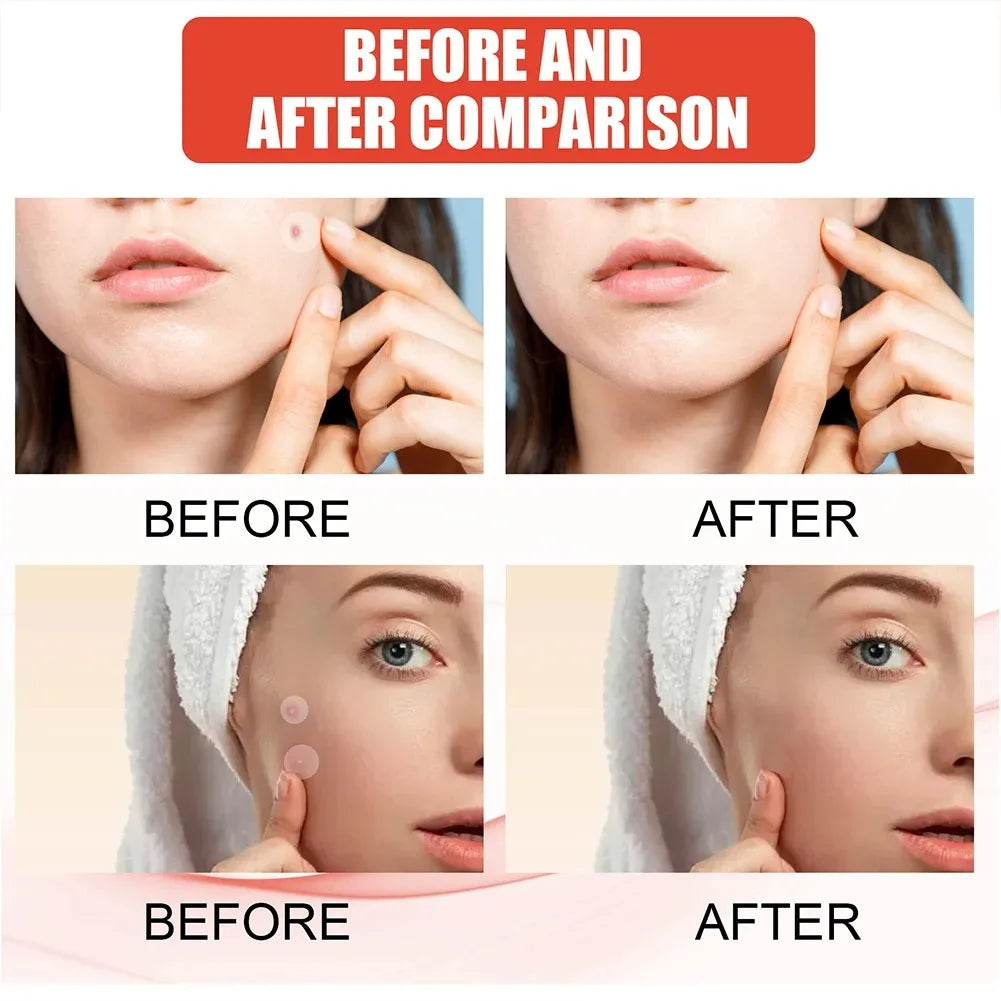 1/2/3 Box Face Acne Patch Invisible Skin Care Pimple Acne Patches Anti-Inflammatory Healing Absorbing Spot Sticker Covering Acne